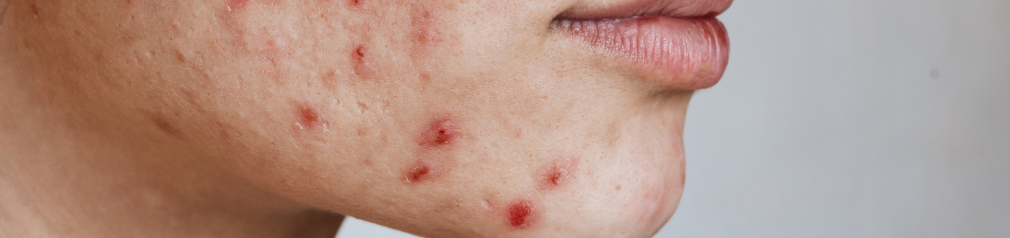 How Bad Can Adult Acne Get?