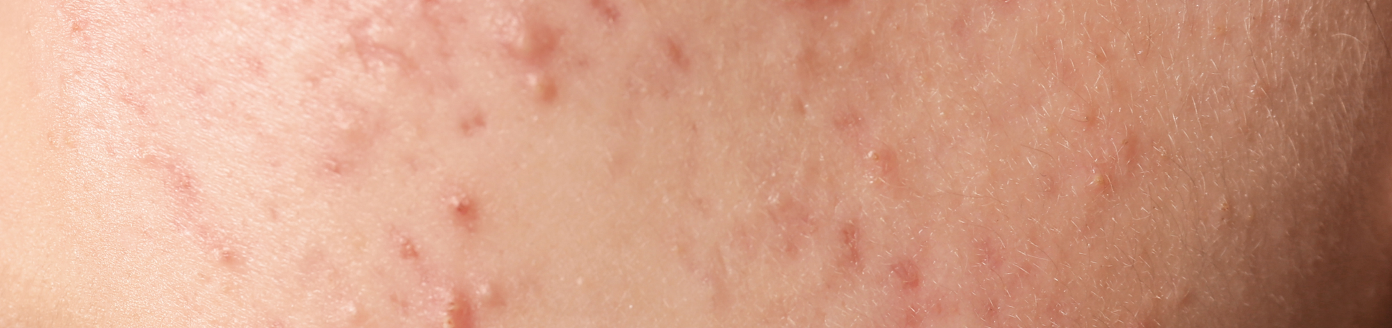 ACNE: The Dreaded 4-letter Word for Adults