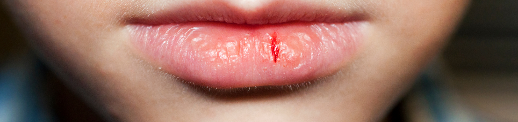 What to use for severe, dry lips