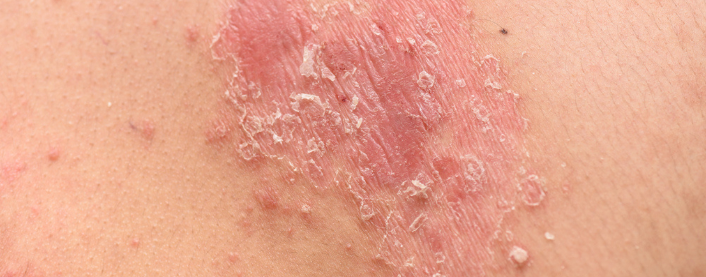 What is Psoriasis and how do you get it? – Bio-First