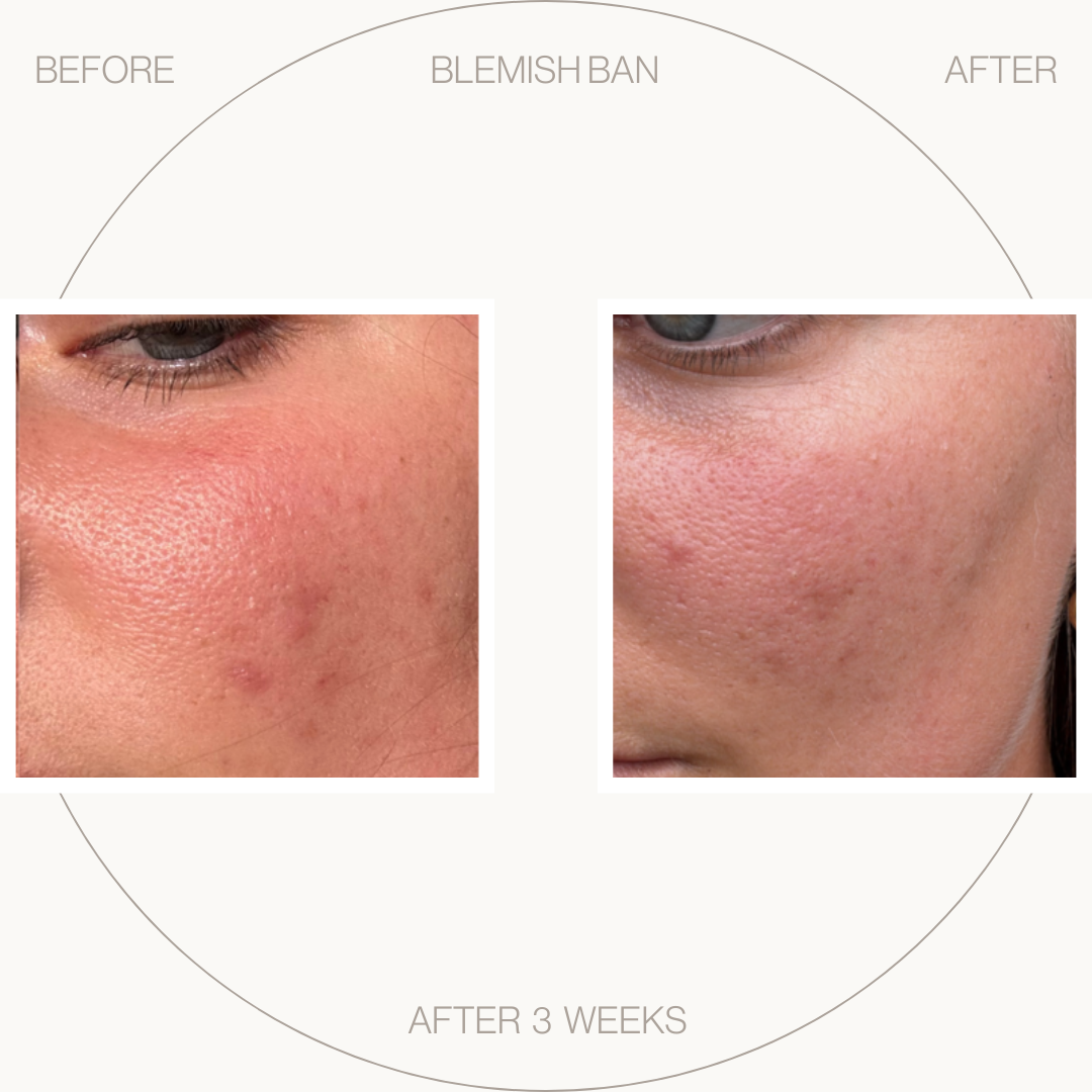 Blemish Ban Gel